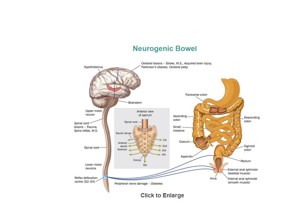 Neurogenic Bowel