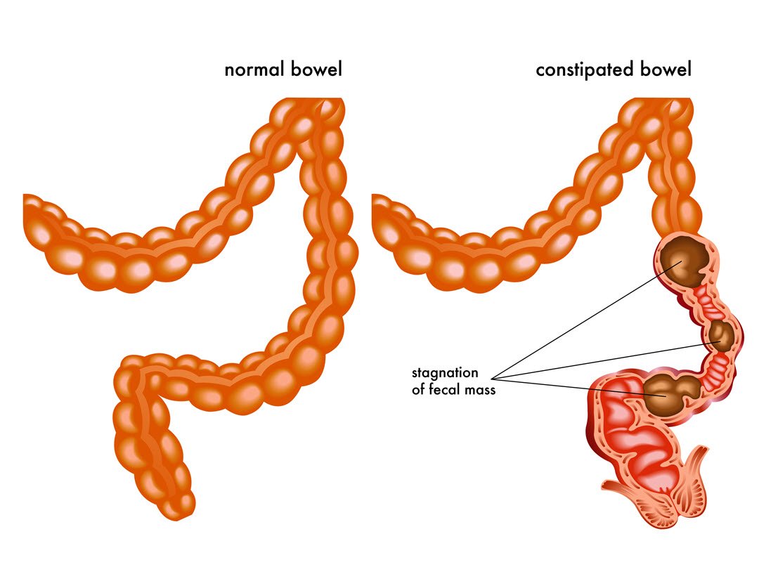 Options to Provide Relief for Chronic Constipation